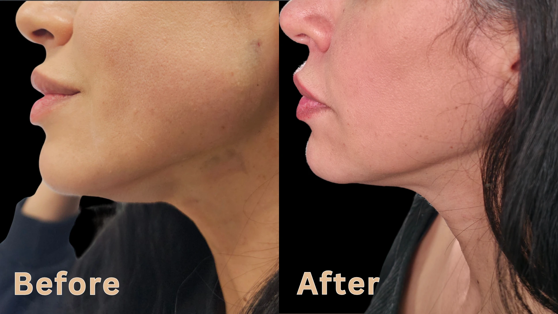 Before and after side profile comparison of a woman's jawline and neck tightening treatment