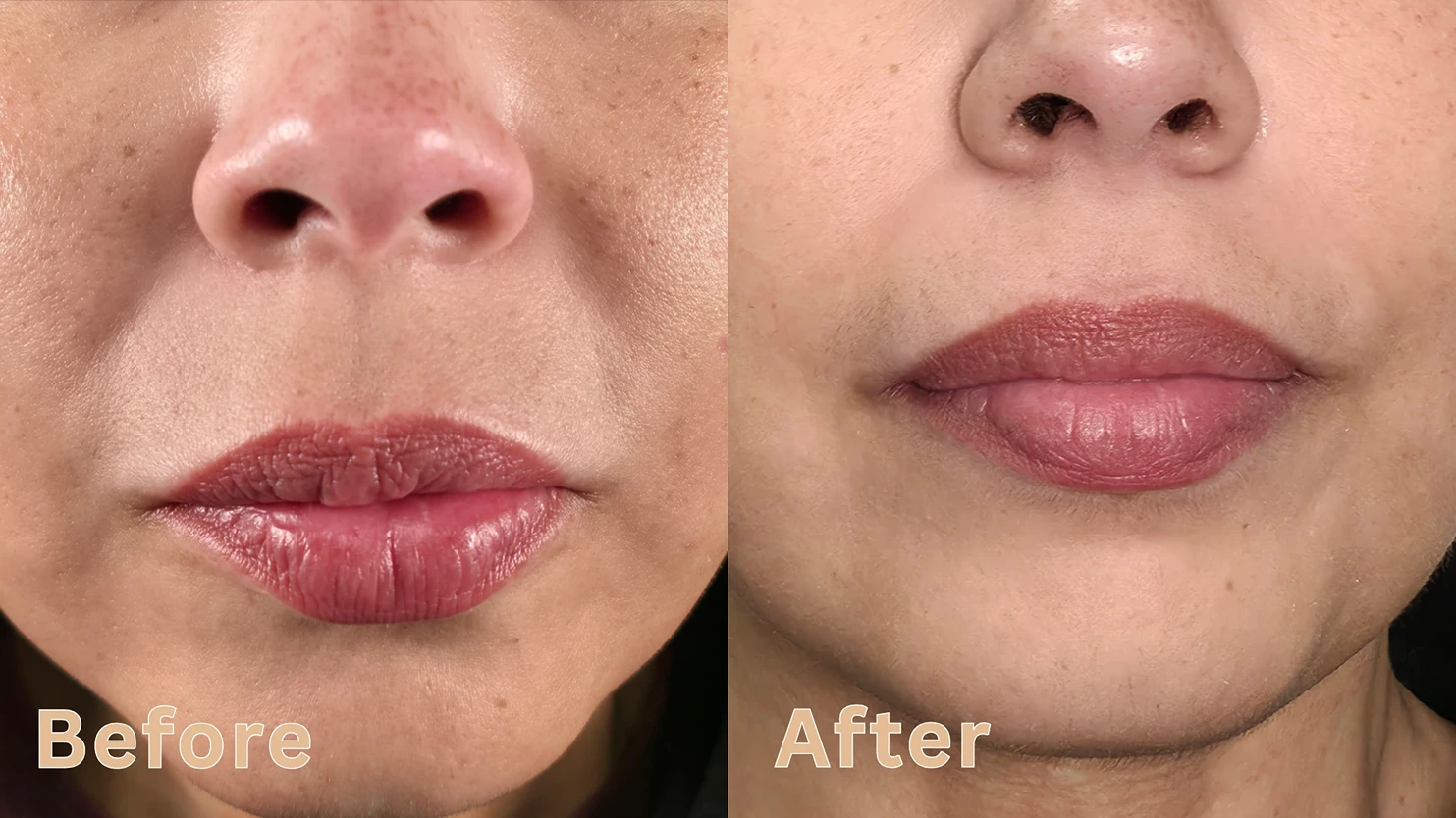 Close-up before and after results of a cosmetic lip enhancement and smile line reduction procedure