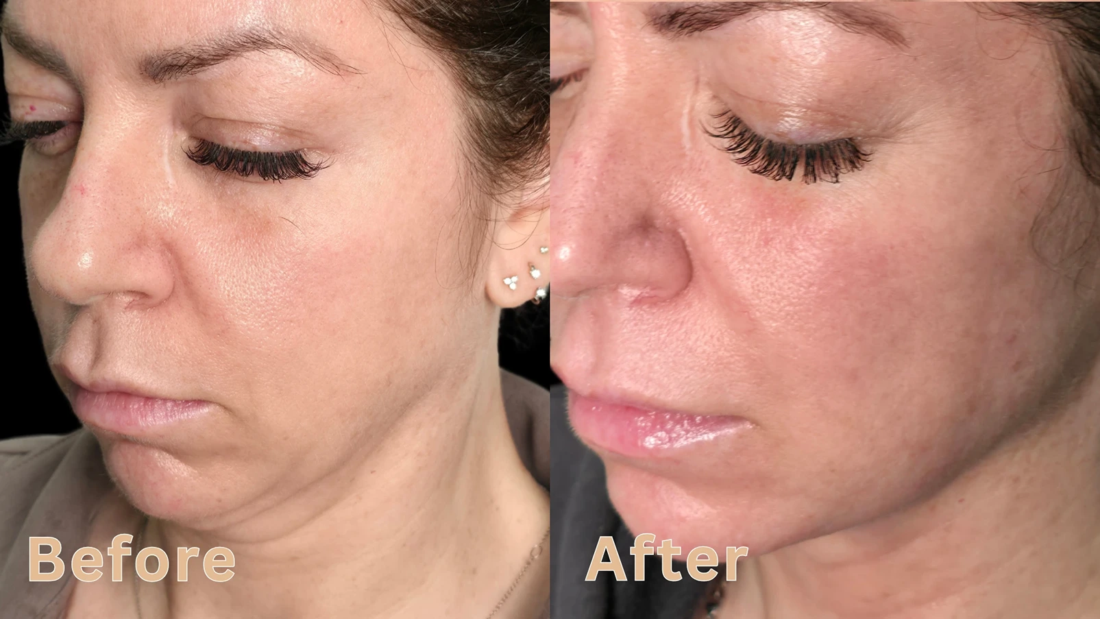 Before and after comparison of a woman's cheek lift and skin rejuvenation treatment from a side view