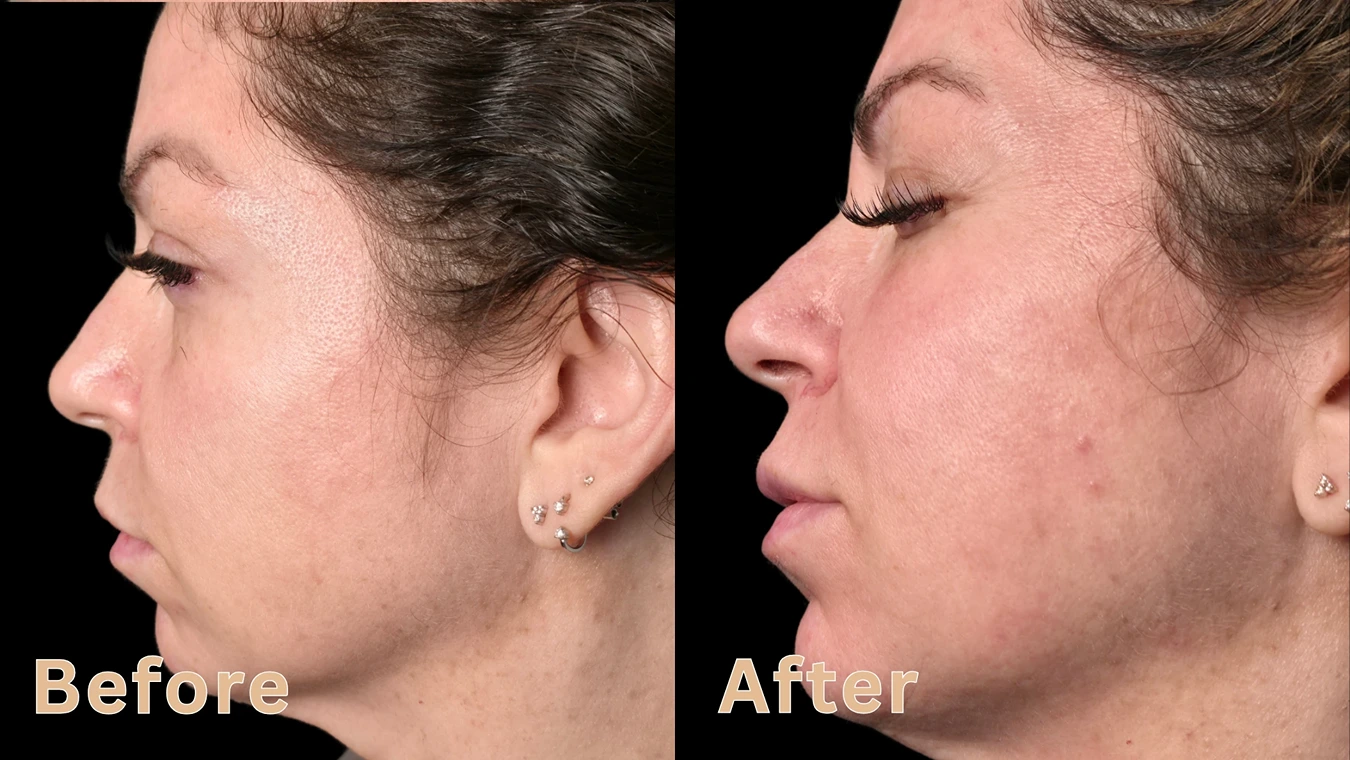 Side-by-side profile comparison showing chin definition and jawline contouring before and after results