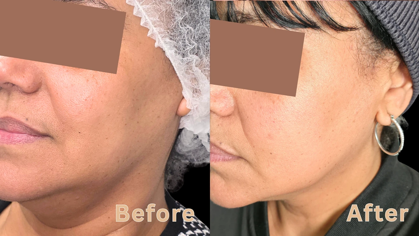 Before and after comparison of a non-surgical facelift and skin tightening treatment on a woman's jawline