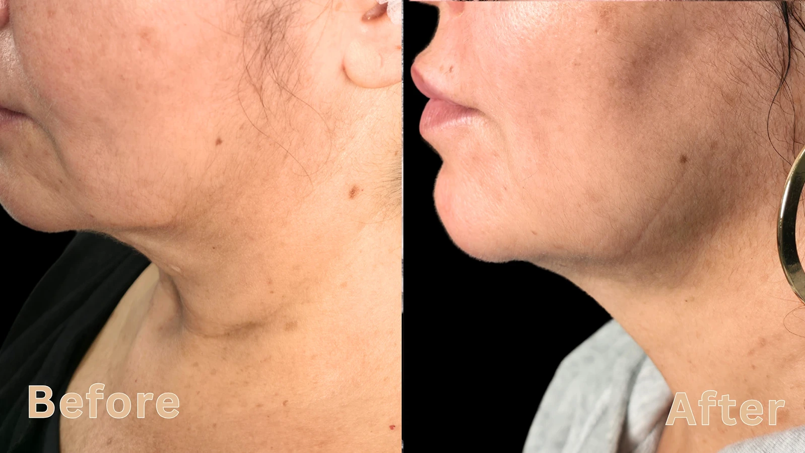 Close-up side profile of a woman's neck and double chin reduction before and after cosmetic treatment