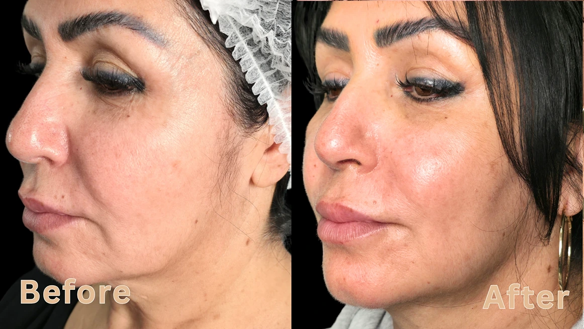 Side view of a woman's face showing cheek volume improvement and skin lifting before and after results