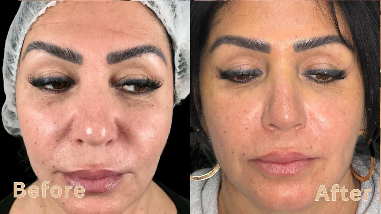 Front view facial rejuvenation comparison showing reduced wrinkles and smoother skin before and after