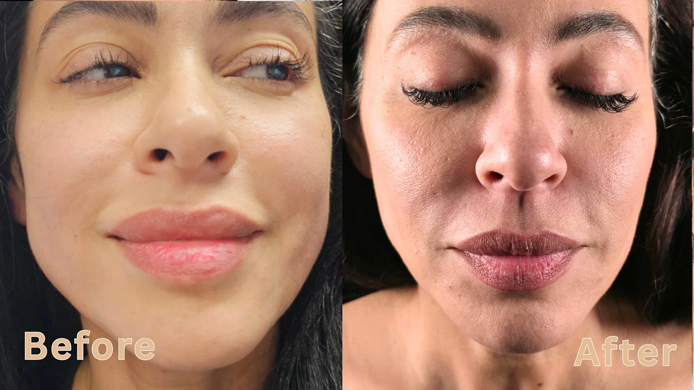 Before and after comparison of a woman's lips and nasolabial folds after dermal filler treatment