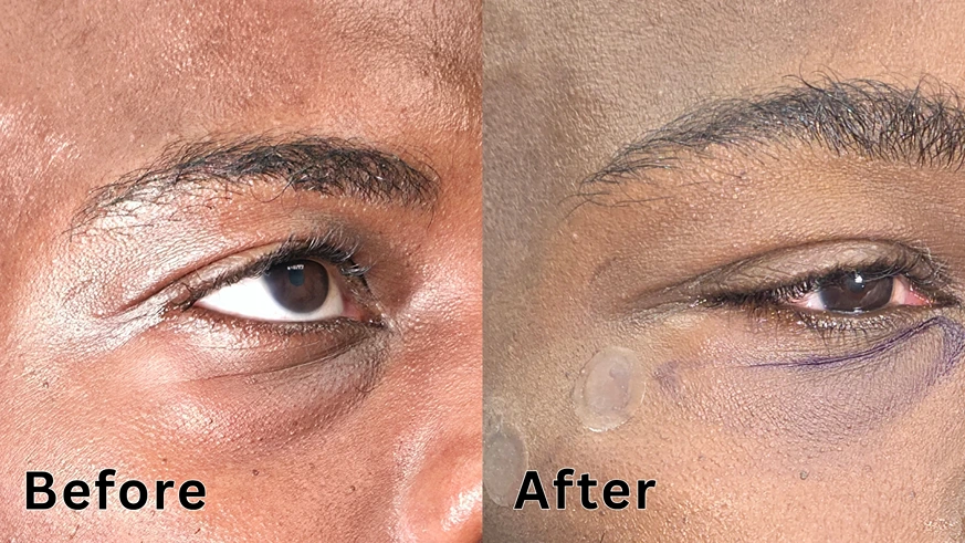 Close-up before and after comparison of an under-eye dark circle and tear trough treatment on dark skin