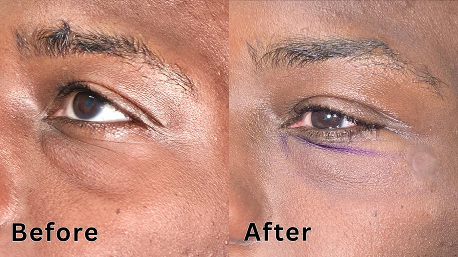 Close-up before and after comparison of under-eye tear trough filler treatment on dark skin with medical markings