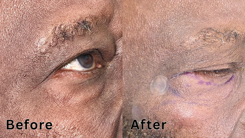 Before and after results of a non-surgical under-eye rejuvenation and hollow correction procedure on a male patient