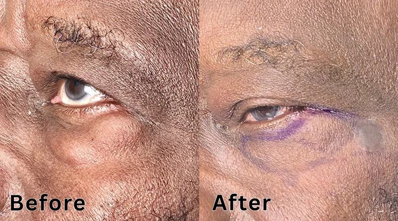 Clinical side-by-side comparison of under-eye bags reduction and tear trough treatment before and after