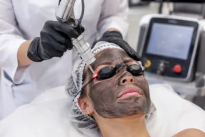 Laser technology used for carbon facial skin rejuvenation