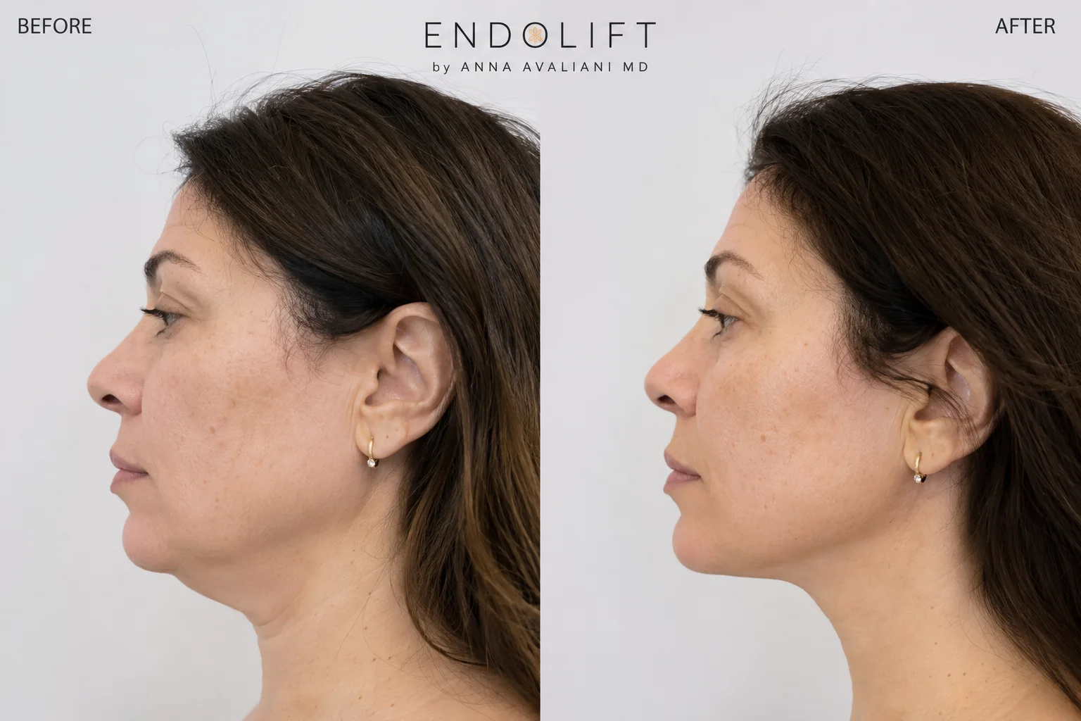 Endo Lift treatment for non-surgical facial skin tightening in Flushing Queens