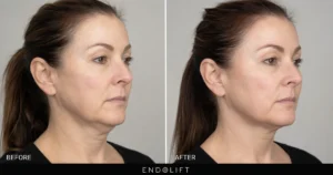 Endo Lift before and after jawline contour improvement