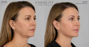 Laser skin tightening before and after facial rejuvenation results