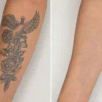 Laser tattoo removal before and after results showing faded tattoo and clear skin