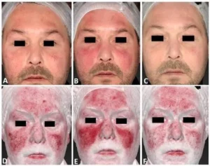 telangiectasia of the face with visible branching blood vessels