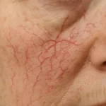 spider angioma face showing radiating red vessels on cheek