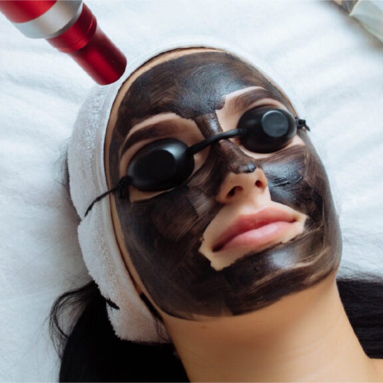 Laser Carbon Peel – The Ultimate Guide to Clear, Radiant Skin