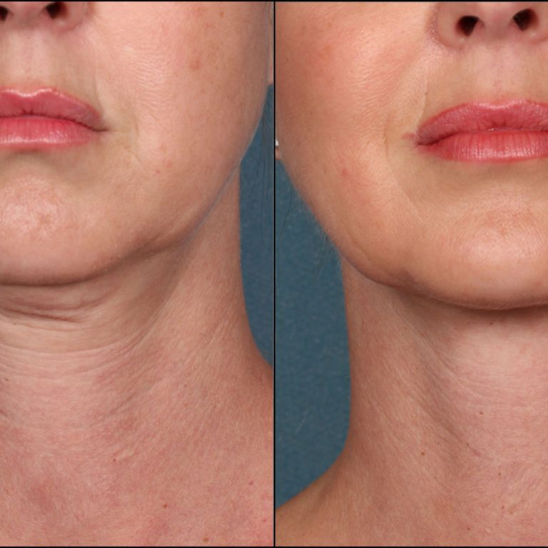 Before-and-After-skin