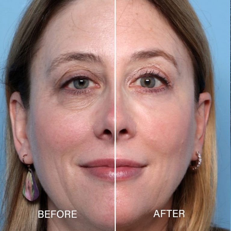 Blepharoplasty-bxa2
