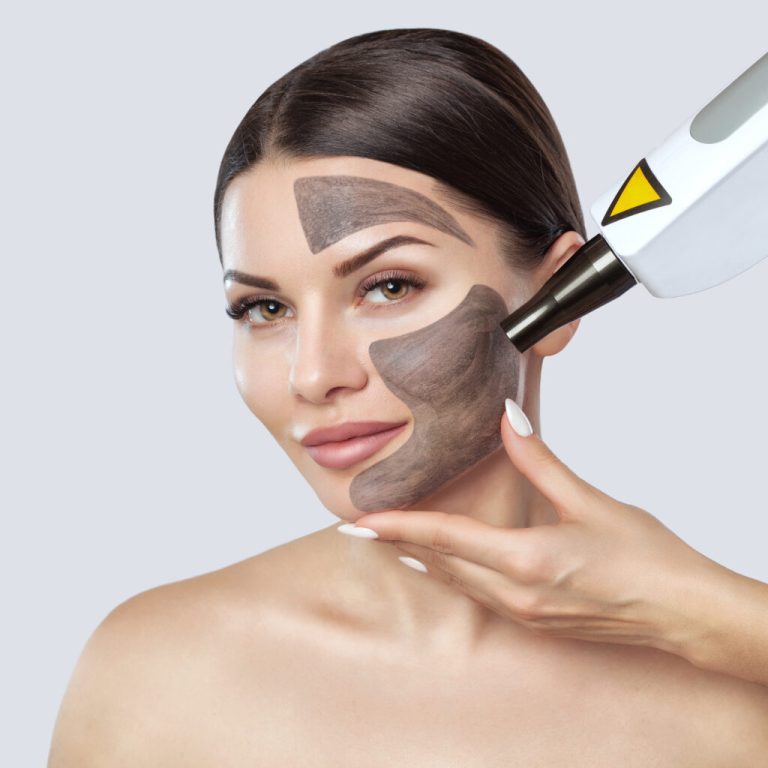 Carbon-laser-facial