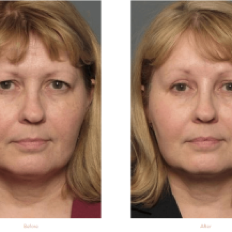 Eyelid-Lift-Surgery-Before-After-Raleigh-Durham-NC-1-768x556-1-300x217