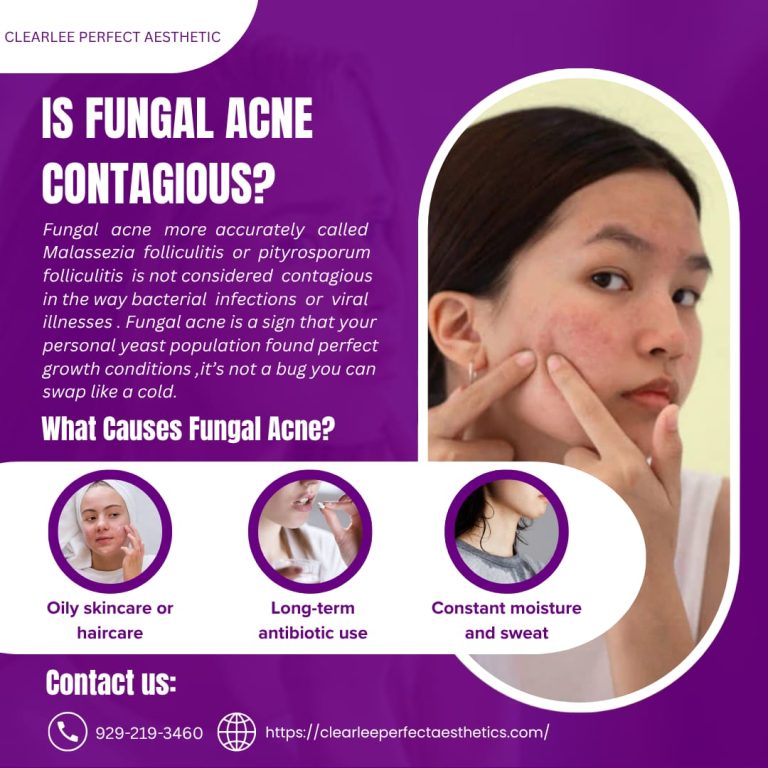 Is Fungal Acne Contagious
