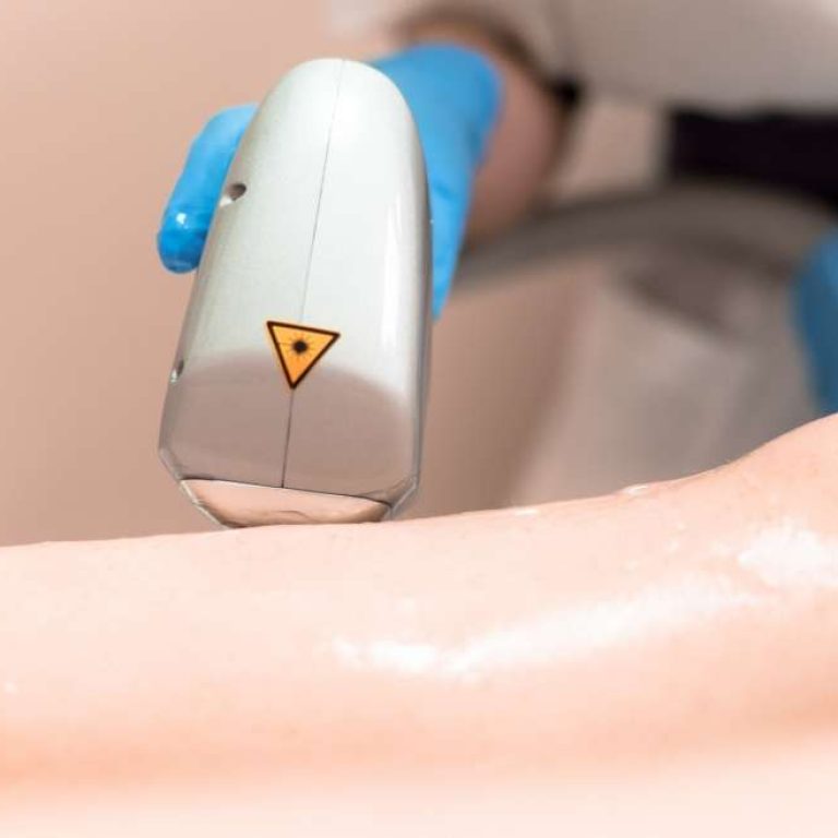 Spider Vein Removal Laser At Clearlee Perfect Aesthetics