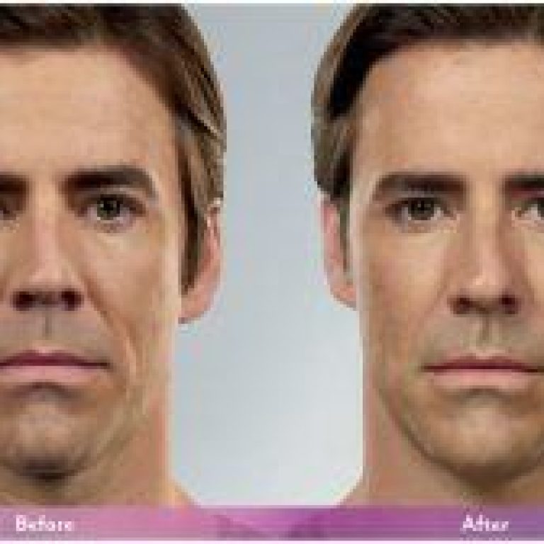 Nashville-Fillers-Progression-Man-300x168-1