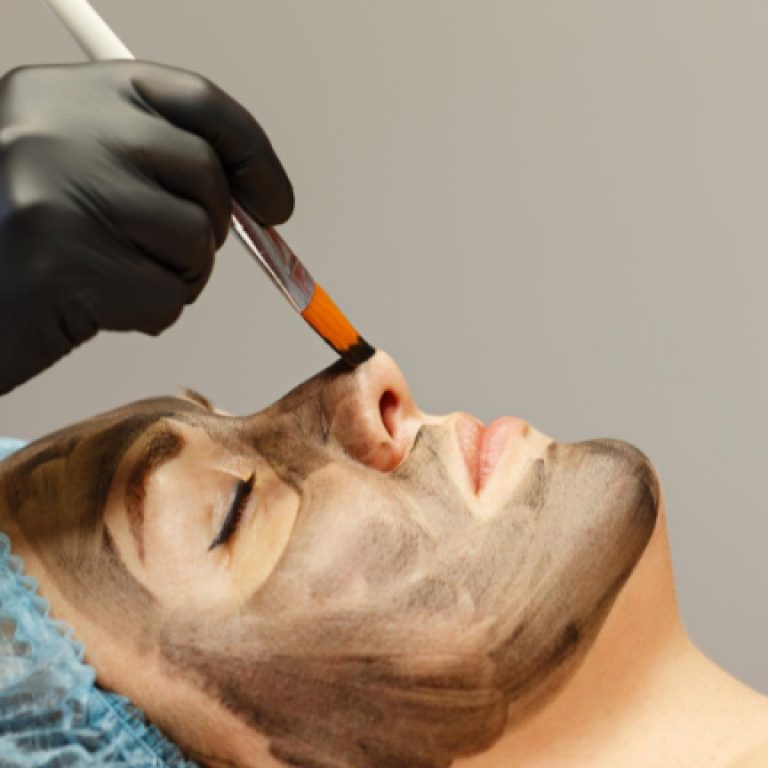 carbon laser peel in nyc