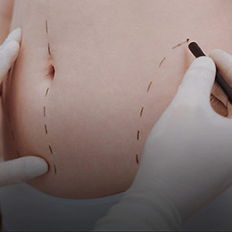 banner-liposuction-mobi-1