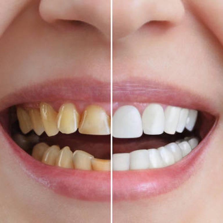 cosmetic dentistry services smile transformation before after