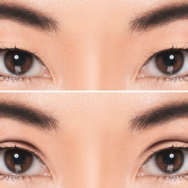 double-eyelid-surgery-678x446-1