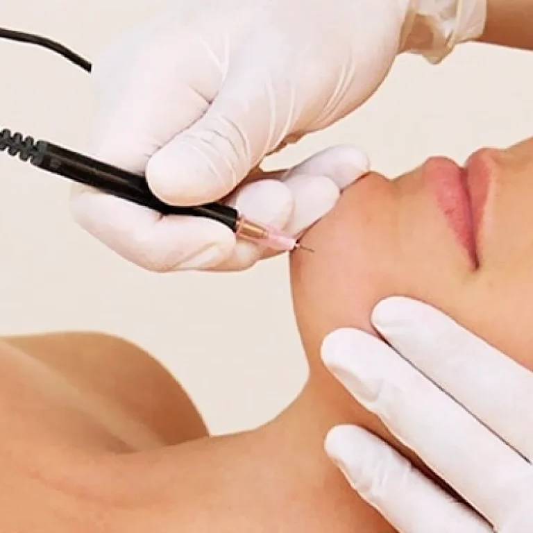 electrolysis-for-hair-removal-265