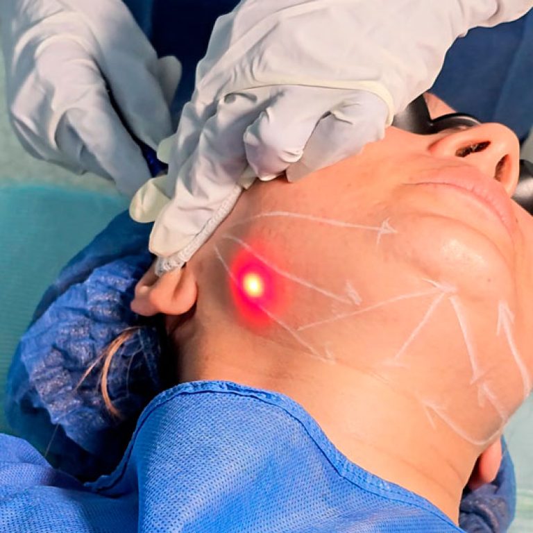 Endolifting laser