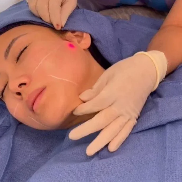 endolift procedure at Clearlee Perfect Aesthetics