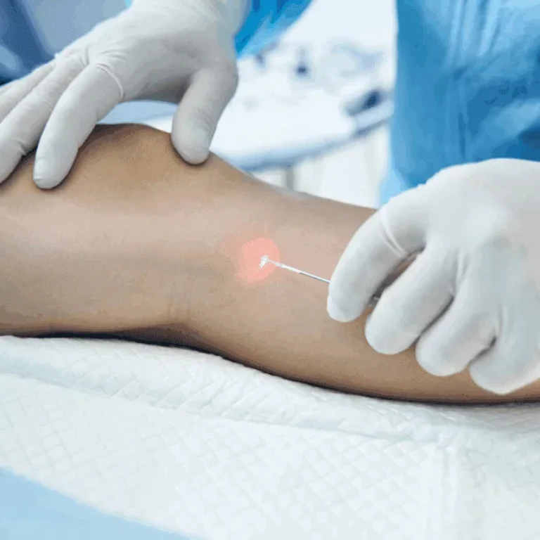 laser vein removal near me treatment process