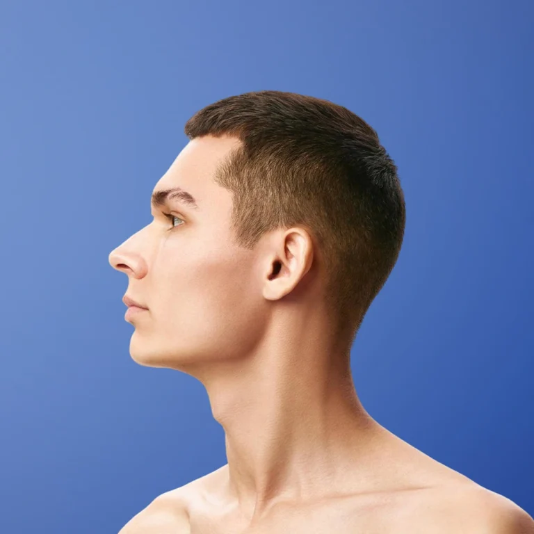jawline filler