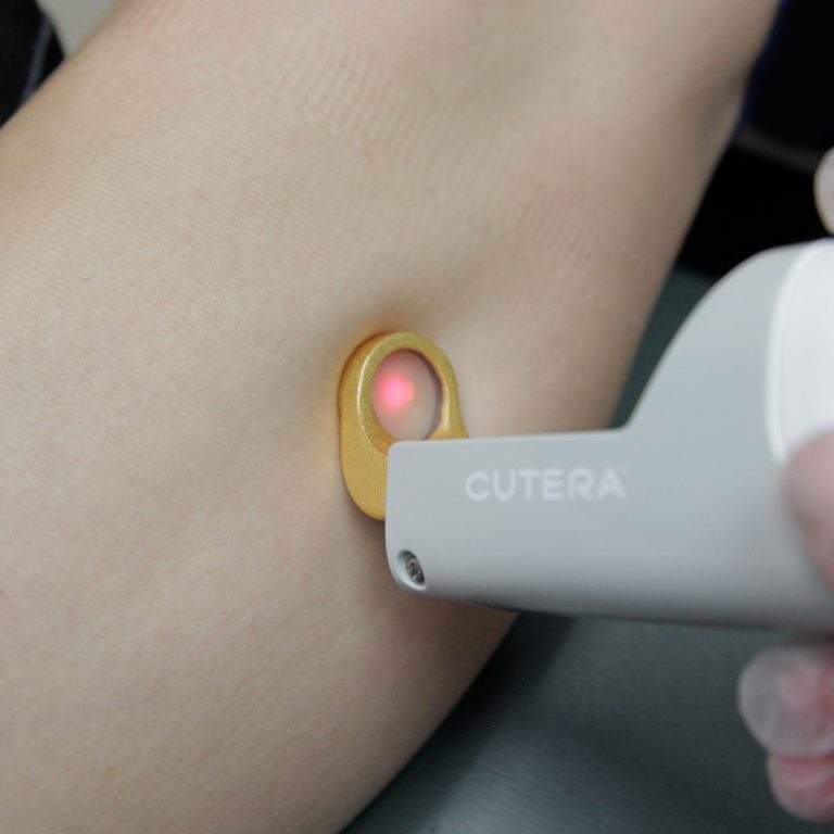 Laser Vein Removal New York I At Clearlee Perfect Aesthetics