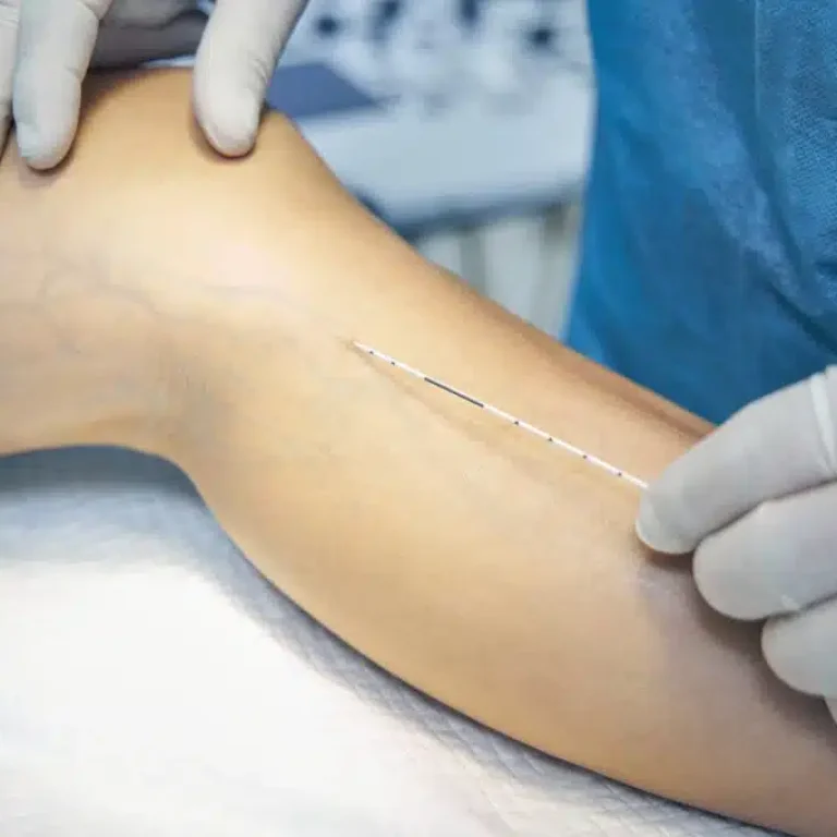 Laser Spider Vein Removal