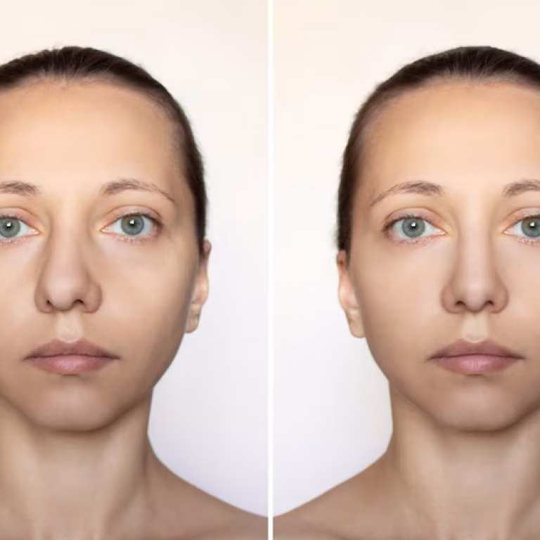 Mini Face Lift Before And After