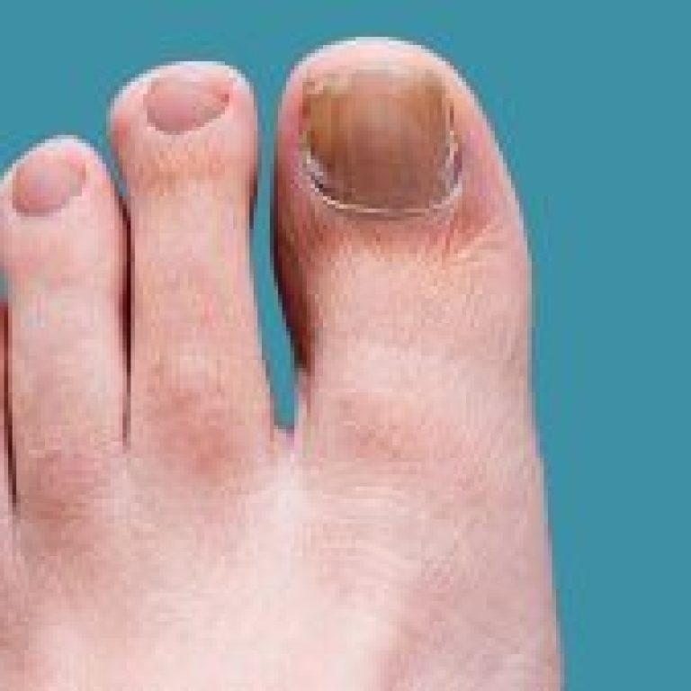 stamp-out-toenail-fungus-722x406-1-300x169